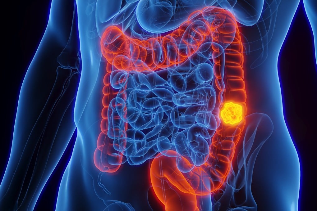 The genomes and transcriptomes of Swedish patients who had colorectal cancer have been analysed by researchers to identify genetic mutations. Photo: Shutterstock