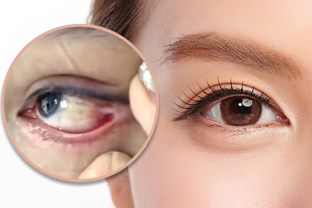 A woman in China has been left with permanent blurred vision following a bungled double eyelid cosmetic procedure. Photo: SCMP composite/Shutterstock/Douyin