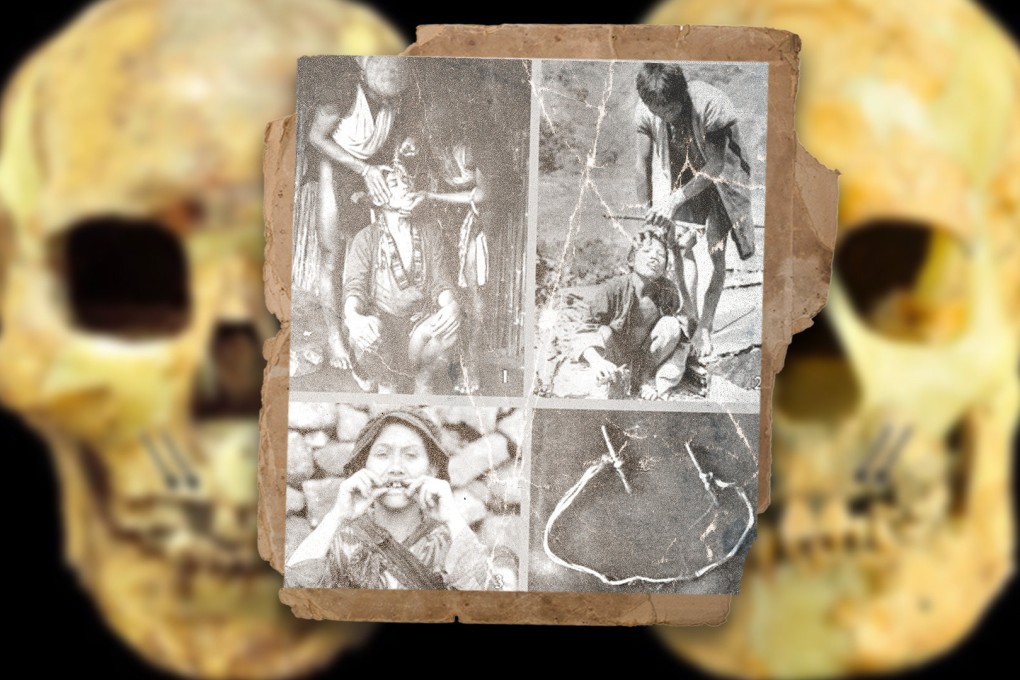 Traditional tooth removal, practised by ancient Austronesians in Taiwan, remains a custom to this day. Photo: SCMP composite/Archaeological Research in Asia