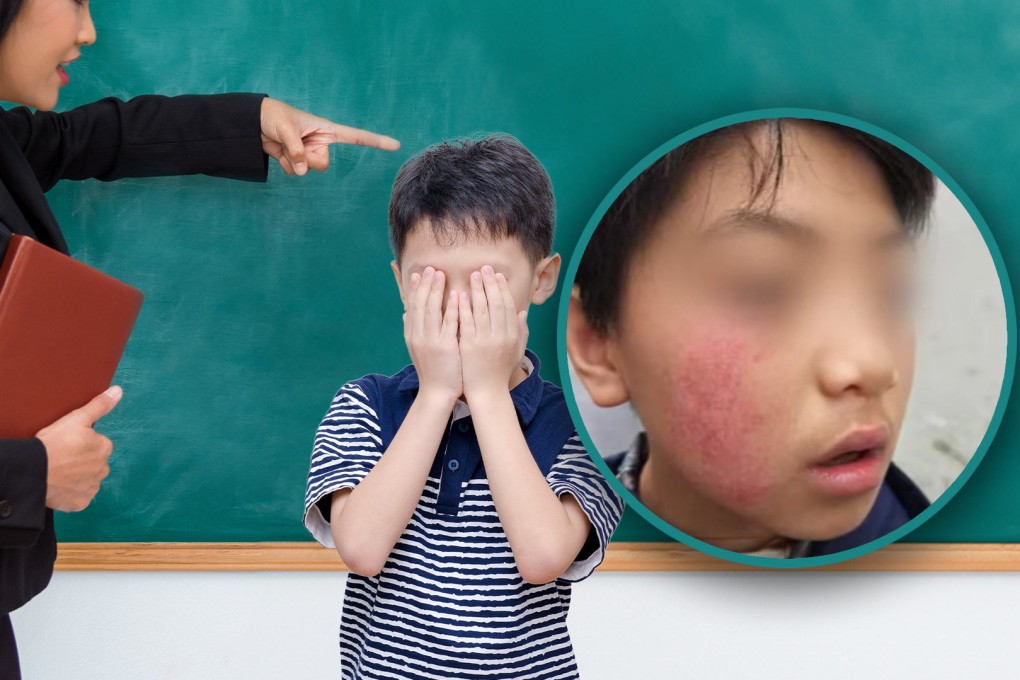 A mother in China has reported that her son experienced a loss of skin pigmentation after allegedly being slapped four times by a teacher. Photo: SCMP composite/Shutterstock/Douyin