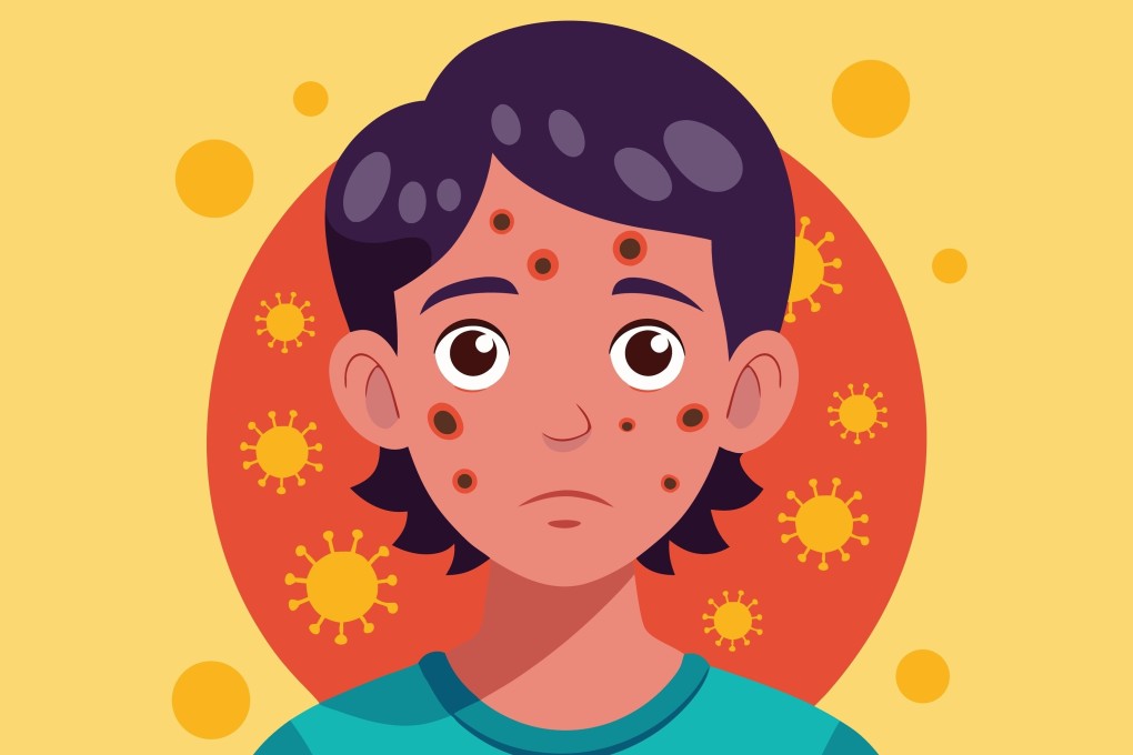 How much do you know about mpox? Photo: Shutterstock