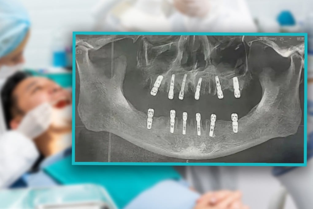 A Chinese man sufferd a heart attack and died after having 23 teeth extracted and 12 implants placed in one day. Photo: SCMP composite/Shutterstock/QQ.com