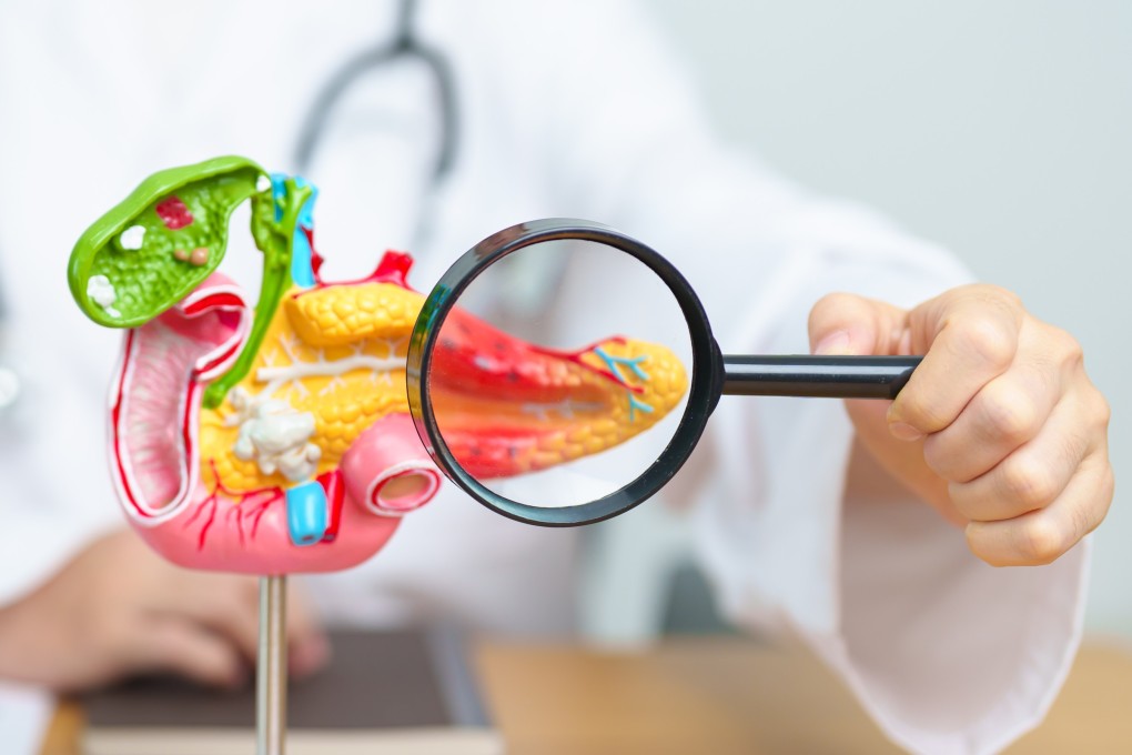 Surgery is the only treatment for pancreatic cancer, and yet in 75  per cent of cases the cancer, one of the deadliest, recurs within a year. A new vaccine in trial offers hope of preventing that. Photo: Shutterstock