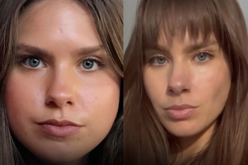 “Moon face” or “cortisol face”, a condition in which the face appears swollen and puffy, is a health concern that has been popping up online. Photo: Instagram/mamamiaaus