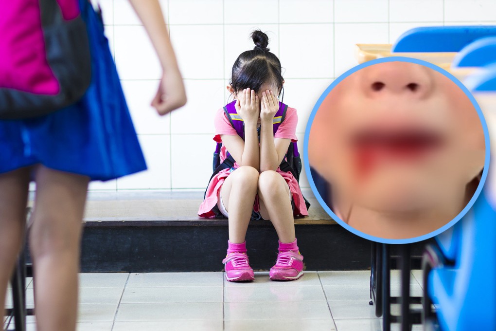A father was criticised for sharing a video of his injured daughter, bullied at school, rather than addressing the bullies. 
Photo: SCMP composite/Shutterstock/Douyin