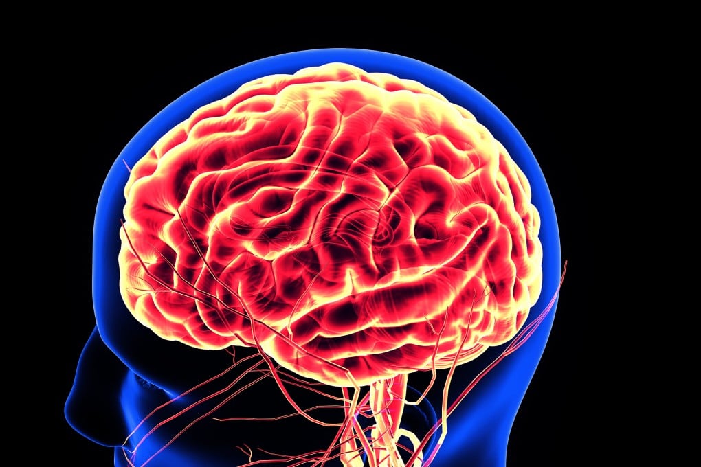 Heart attacks restrict the blood flow the brain, often causing severe damage. Photo: Shutterstock