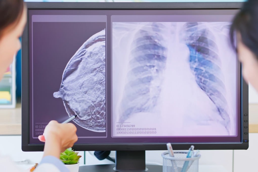 A woman is shown her mammogram test results on a computer screen. Photo: Shutterstock