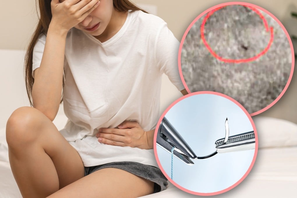 A Thai woman has gone viral on social media after revealing that a needle was accidentally left in her vagina during childbirth 18 years ago, causing her ongoing pain. Photo: SCMP composite/Shutterstock/Pavena Foundation for Children and Women