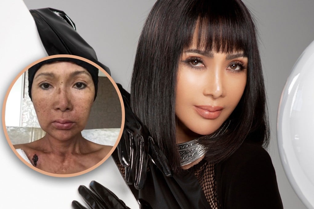 Zhang Mi, een kankeroverlever sinds haar diagnose van amandel- en orofaryngeale kanker in 2019, heeft haar derde kankergevecht aangekondigd. Foto: SCMP composite/Weibo