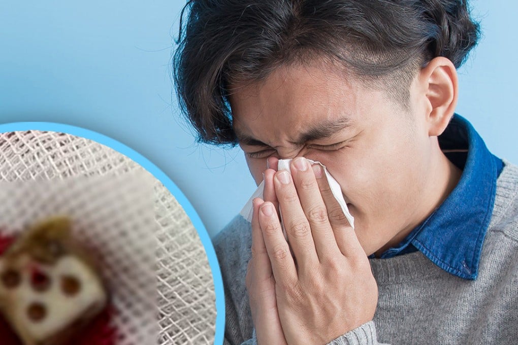 The man recalled that dice may have accidentally gone up his nose when he was about three or four, though it is unclear how it happened. Photo: SCMP composite/Shutterstock/Douyin