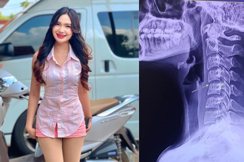 Left: Thai singer Chayada Prao-hom, who died on Sunday. Right: An x-ray image posted by Chayada to social media. Photos: Facebook / Chayada Prao-hom