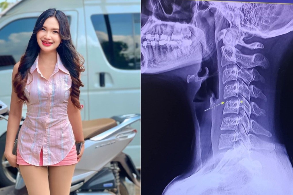 Left: Thai singer Chayada Prao-hom, who died on Sunday. Right: An x-ray image posted by Chayada to social media. Photos: Facebook / Chayada Prao-hom