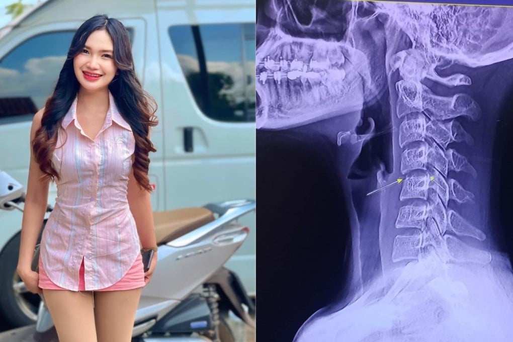 Left: Thai singer Chayada Prao-hom, who died on Sunday. Right: An x-ray image posted by Chayada to social media. Photos: Facebook / Chayada Prao-hom