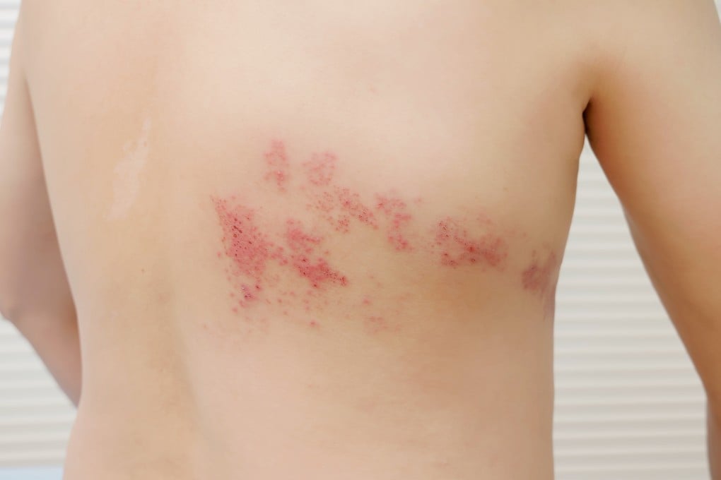 The shingles virus generally only appears on one side of the body, not both. Photo: Shutterstock