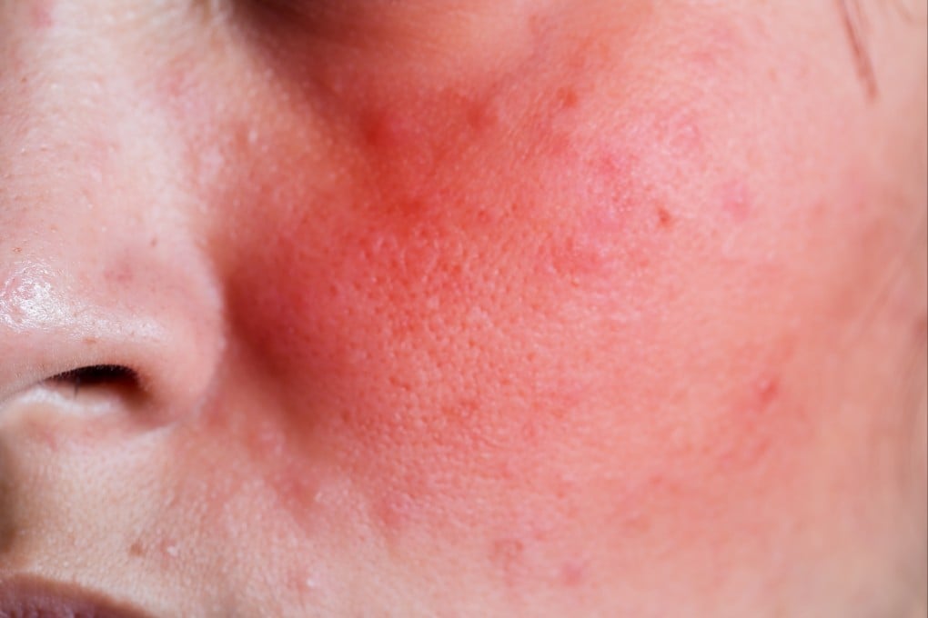 A young woman with a rash on her face. Photo: Shutterstock