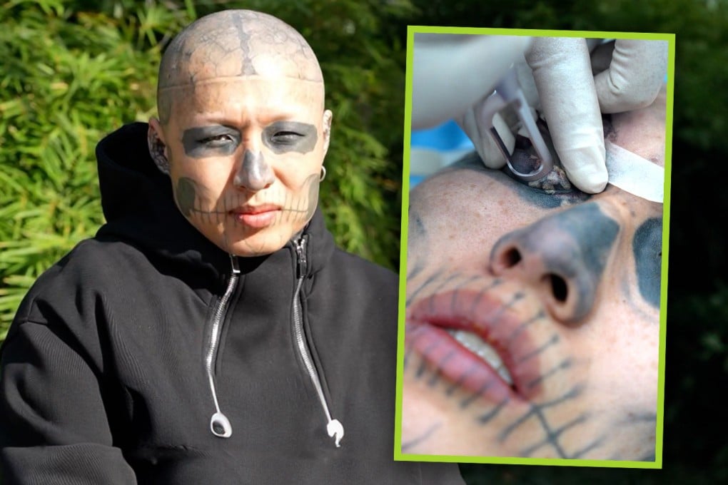 A young man in China is enduring an intense amount of pain to have extensive tattoos all over his head and body removed. Photo: SCMP composite/Douyin