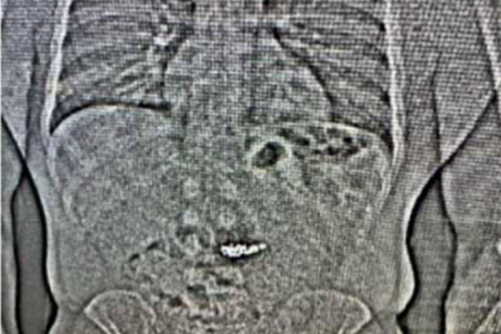 An X-ray shows what are believed to be two diamond earrings that were stolen from a Tiffany & Co. jewelry store in central Florida and were swallowed by the suspect. Image: Orlando Police Department office via AP