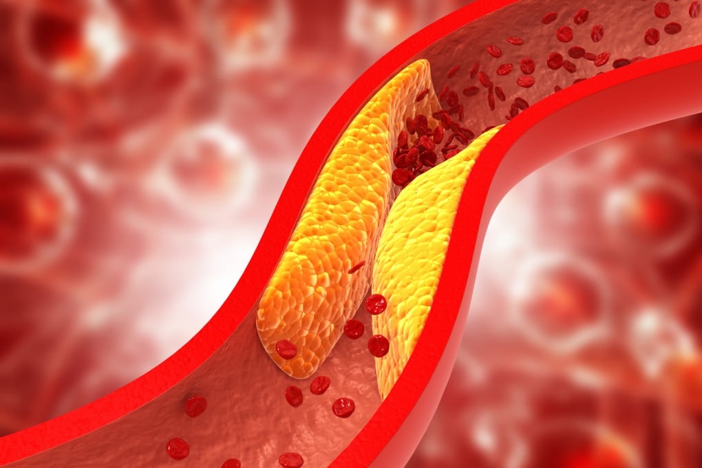 A build-up of plaque – a deposit of fatty substances, cholesterol and cellular waste – in the arteries can lead to blood clots, stroke and heart attacks. Illustration: Shutterstock