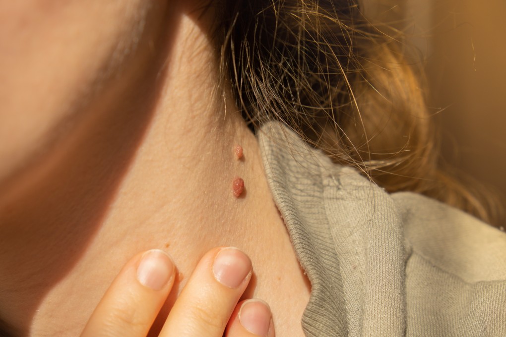 If you regularly check your body for changes, you can detect cancer early. Here is how, from spotting moles, possibly a sign of skin cancer, to feeling for breast lumps. Photo: Shutterstock