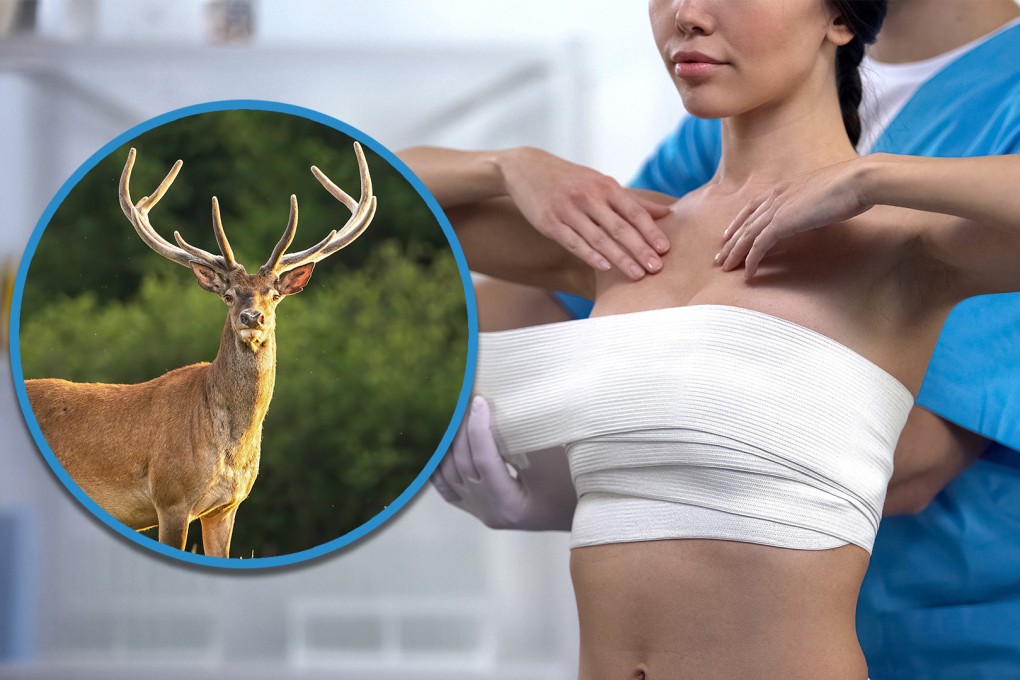 A woman in China who underwent a US$332,000 breast augmentation  procedure was shocked to find that her implants contained the DNA of cattle. Photo: SCMP composite/Shutterstock