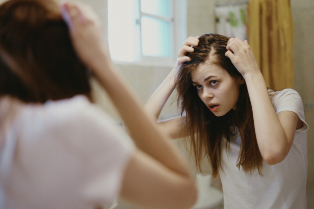 A 1970s blood pressure drug was repurposed in the 1990s as a topical hair loss solution. A recent study shows taking minoxidil as a pill is more effective and convenient. Photo: Shutterstock