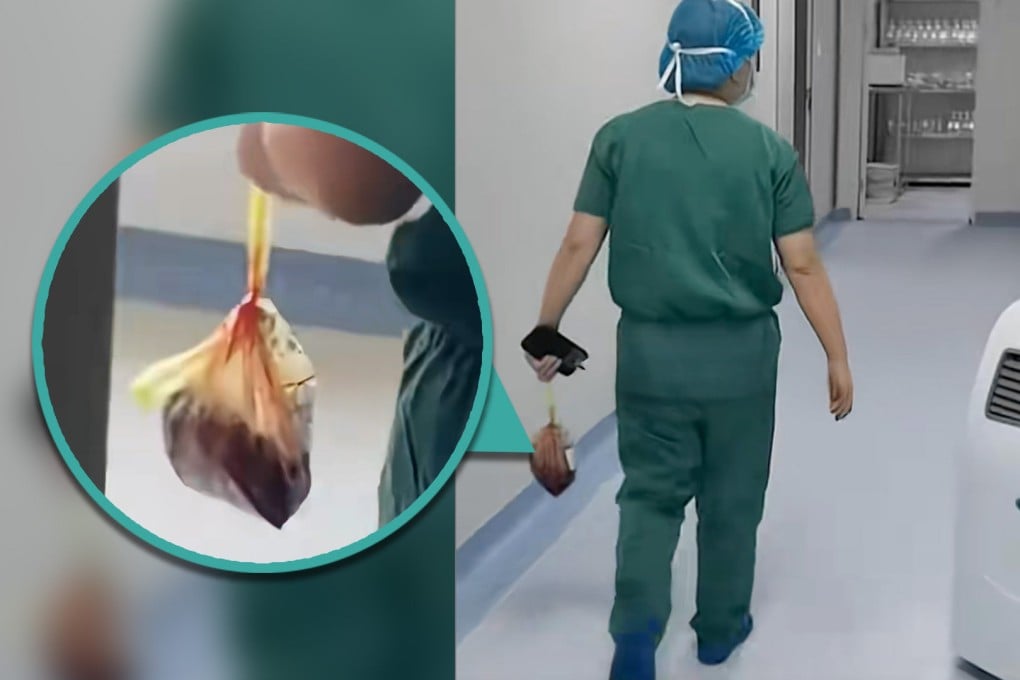 A doctor in China has been fired for stealing the placentas of new mothers, then selling them as Traditional Chinese Medicine ingredients. Photo: SCMP composite/Douyin