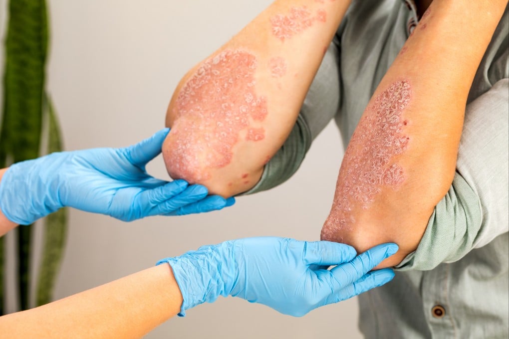 Dangerous and often lethal fungal infections are on the rise, and the World Health Organization has warned of critical global gaps in the ability to diagnose and treat them. Photo: Shutterstock