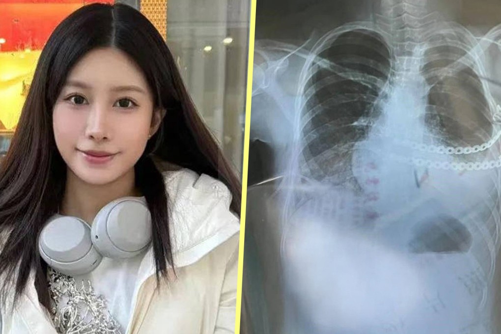 A woman in China with undersized chest muscles wears a “jewellery breast” to boost her self-esteem. Photo: SCMP composite/The Paper