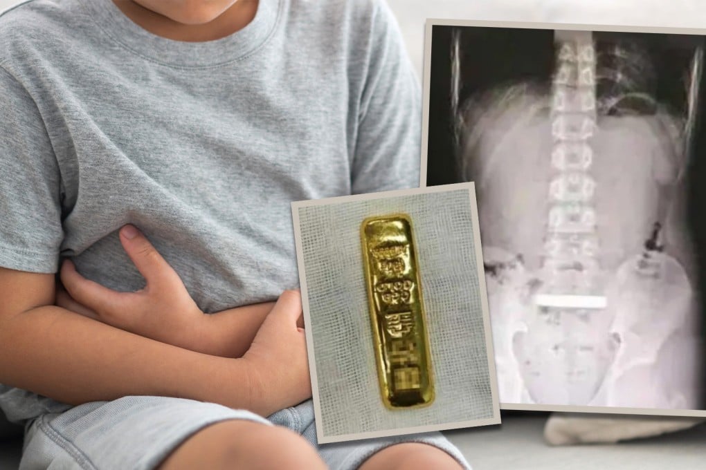 A Chinese boy’s distended abdomen prompted a visit to the doctor, who found that he has ingested a gold bar. Photo: SCMP composite/Shutterstock/Douyin