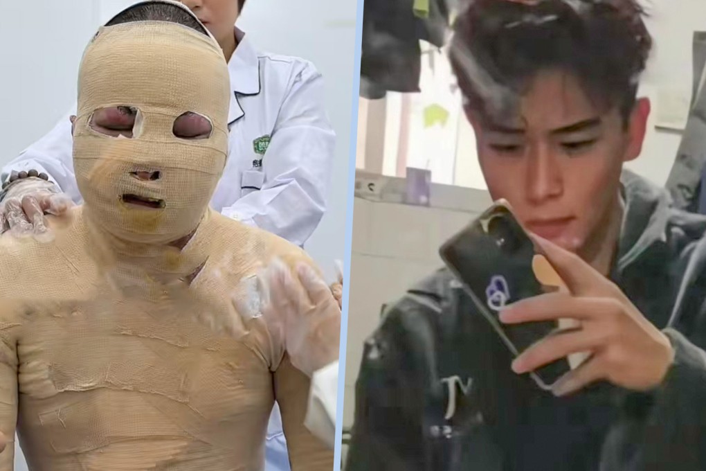 A young man in China suffered 90 per cent burns when the battery of his friend’s electric bicycle exploded inside their flat. Photo: SCMP composite/Douyin