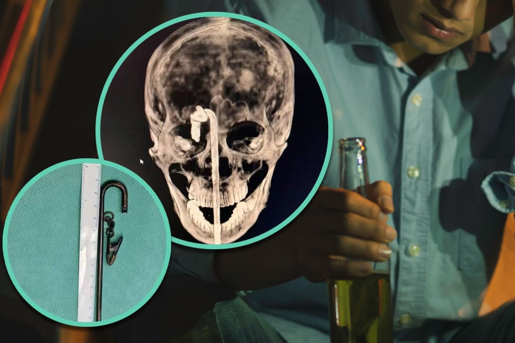 A drunk man in China needed 10 hours of life-saving surgery after he slipped and impaled himself on a metal rod. Photo: SCMP composite/Shutterstock/Douyin