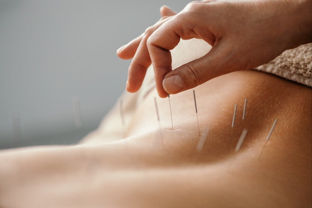 Registered traditional Chinese medicine practitioners in Hong Kong must follow a set of guidelines to prevent infection during acupuncture therapies. Photo: Getty Images