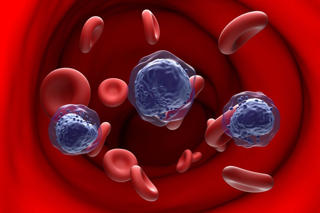 AML (acute myeloid leukaemia) is a cancer that causes the bone marrow to produce a large number of abnormal blood cells, like these pictured in purple. Illustration: Shutterstock