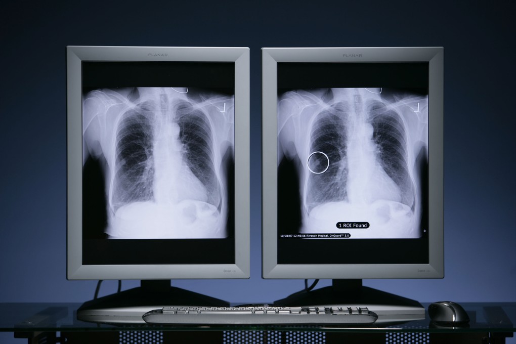 Breakthrough drug trial brings hope to lung cancer fighters in China and US