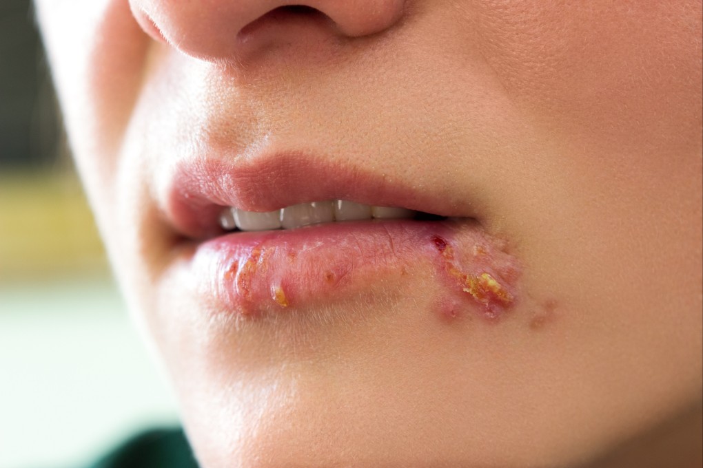 Symptoms of oral herpes, which is caused by the herpes simplex virus 1 (HSV-1), can include painful blisters (cold sores) or open sores (ulcers) in or around the mouth or lips. A new study has found that a protein in HSV-1 is required to activate the immune system and reawaken the virus when it is dormant. Photo: Shutterstock