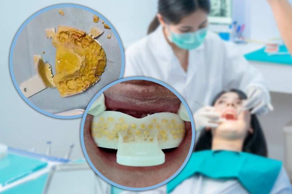 A woman in China almost suffocated after she performed a botched home dentistry job using a cheap teeth-moulding kit she bought online. Photo: SCMP composite/Shutterstock/ifeng