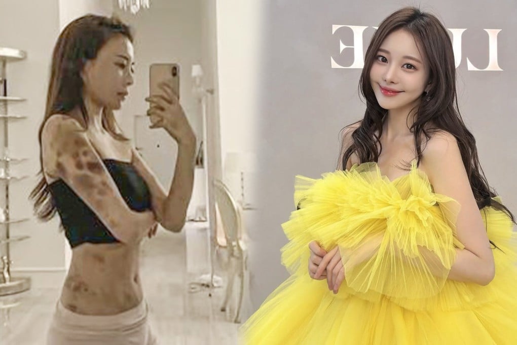 A South Korean influencer who suffered extensive bruising after being given so-called health injections at a clinic has won a four-year legal battle for justice. Photo: SCMP composite/Facebook/IG@minyoung_aori
