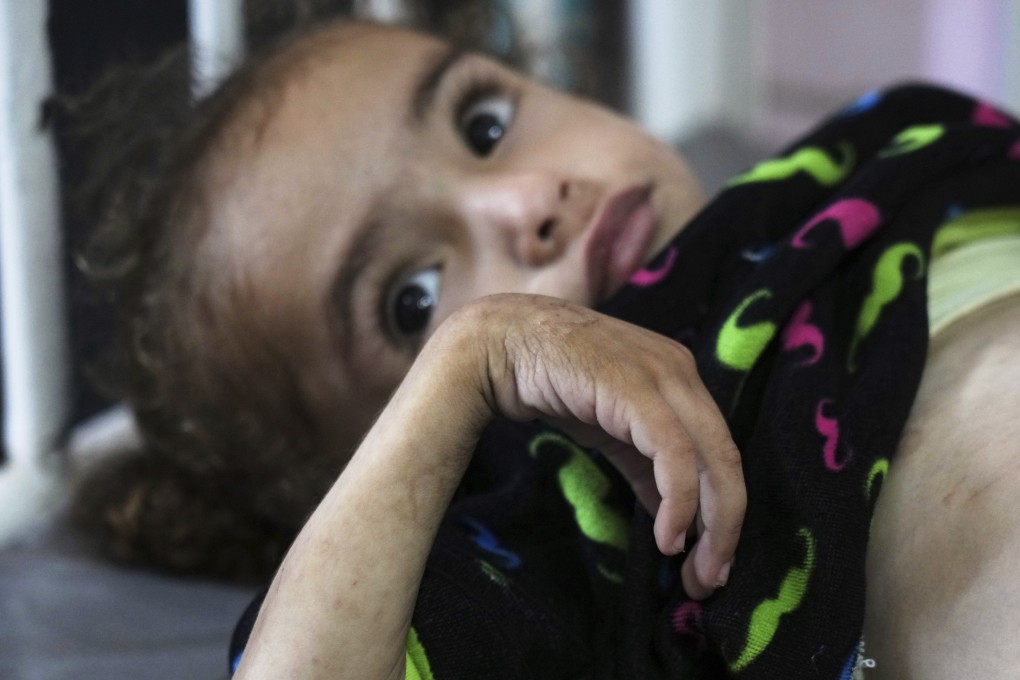 Palestinian girl Mayar al-Arja, 2, who suffers from malnutrition. Photo: AP