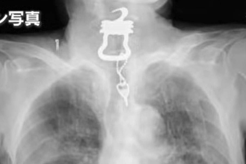 X-ray of the key that was lodged in the elderly man’s throat. Photo: Handout