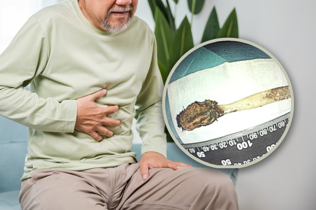 Pria 64 Tahun Operasi 80 Menit Angkat Sikat Gigi dalam Usus Selama 52 Tahun