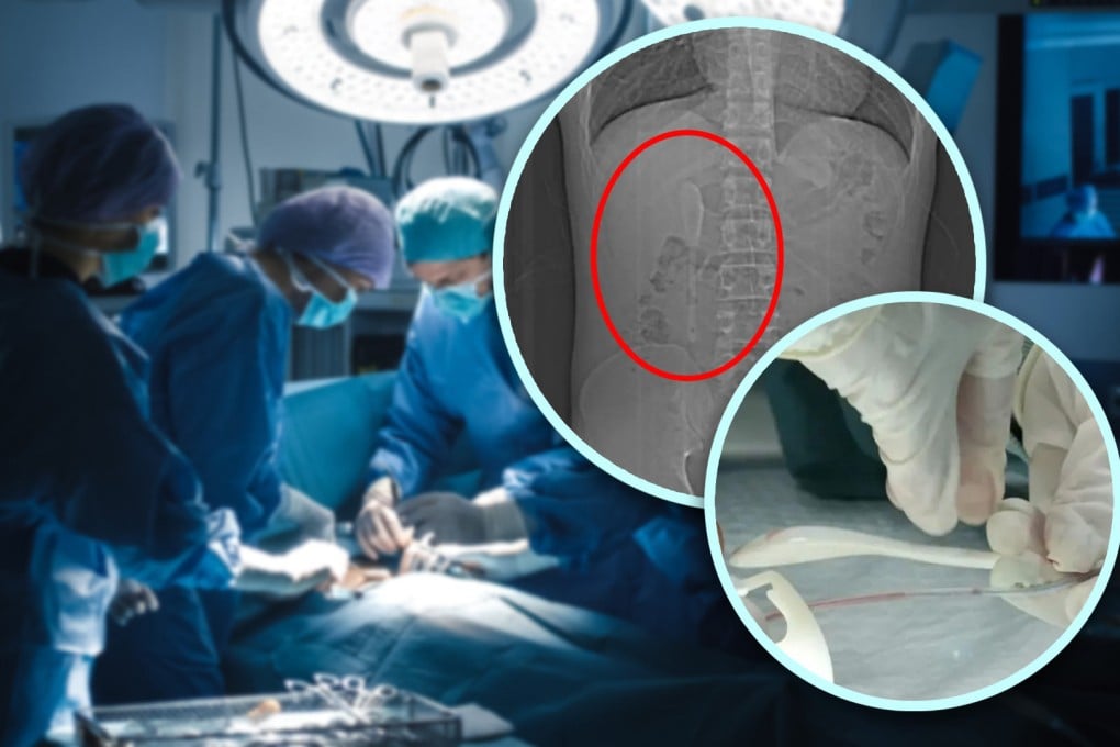 A Chinese man, under the influence of alcohol, mistakenly swallowed a coffee spoon in Thailand, believing it was part of a dream, and only realised the error five months later. Photo: SCMP composite/Shutterstock/QQ.com