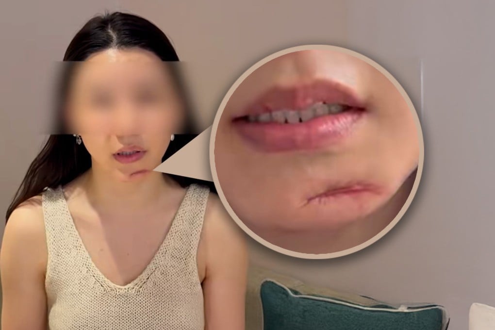 A woman in China is seeking compensation after botched surgery left her with a six-centimetre-long scar on her chin. Photo: SCMP composite/Douyin