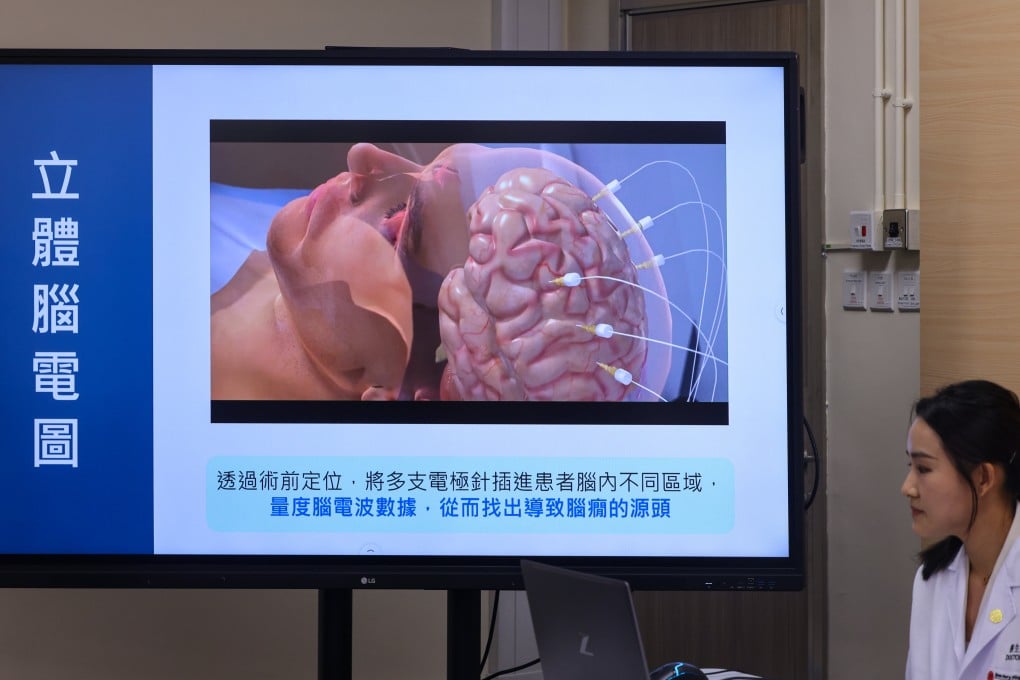 The new robotic system means doctors in Hong Kong can use a more accurate and less invasive approach to identify the sources of epilepsy conditions that are untreatable with medication. Photo: Nora Tam