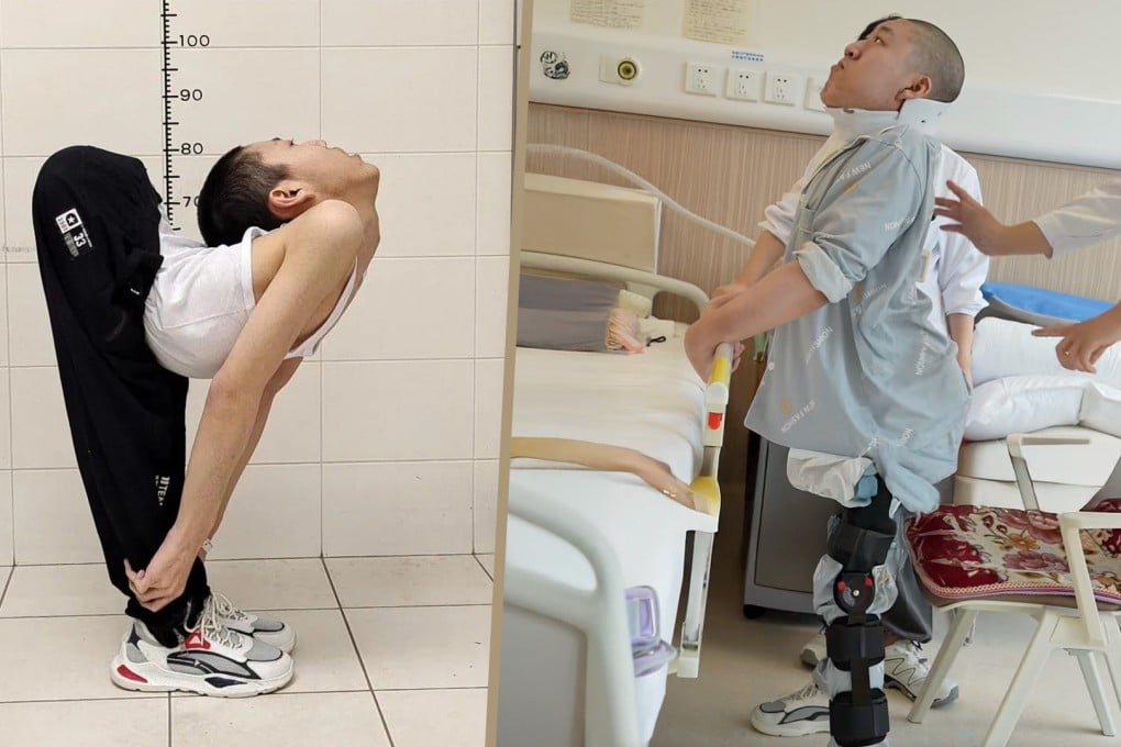 China’s “folded boy” stands upright for the first time after undergoing complex surgeries to break and reset his bones. Photo: SCMP composite/news.pku.edu.cn/Douyin