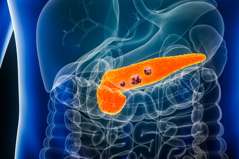 Analysis of samples from patients with pancreatic, breast and colorectal cancers showed cells that act as the “intelligence agents” of the immune system can become severely depleted as the tumour progresses. Sildenafil is able to reverse the process, the research team says. Photo: Shutterstock