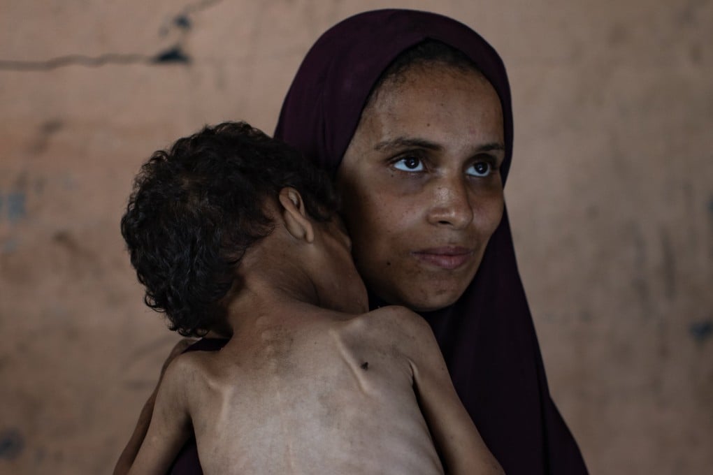 Palestinian child Yazan Abu Foul, aged 2, is cared for by his mother Naima, as he suffers from severe malnutrition. Photo: EPA