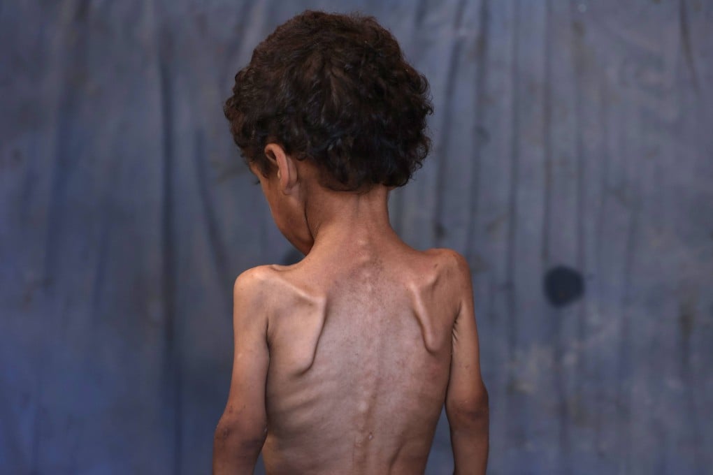 Yazan, a malnourished 2-year-old Palestinian boy, stands with his back turned in his family’s damaged home in the Al-Shati refugee camp, west of Gaza City, on July 23. Photo: AFP