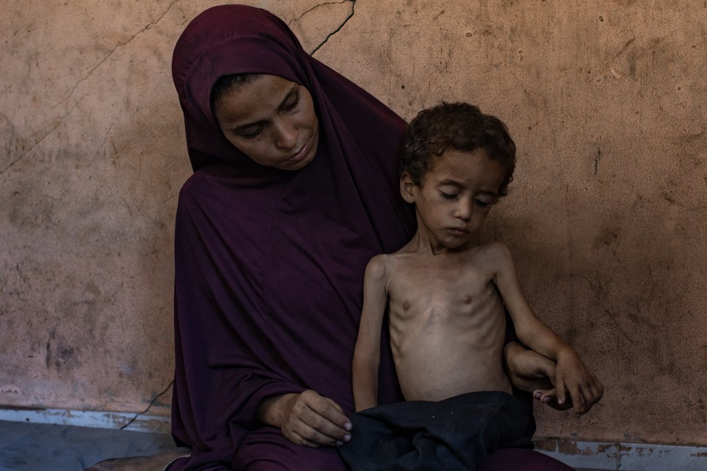 Palestinian child Yazan Abu Foul, aged two, is cared for by his mother Naima, as he suffers from severe malnutrition due to the acute shortage of food in the Gaza Strip. Photo: EPA