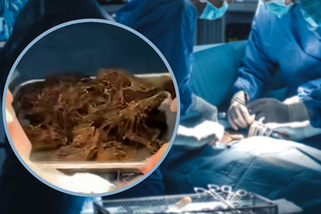 Remaja di Cina Alami Pembesaran Perut Akibat Menelan Rambut Sendiri