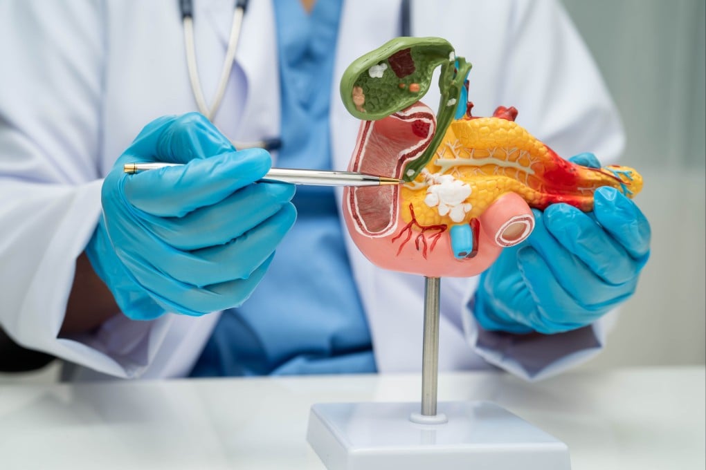 Pancreatic cancer is the sixth-leading cause of global cancer mortality, according to the Global Cancer Observatory. Photo: Shutterstock